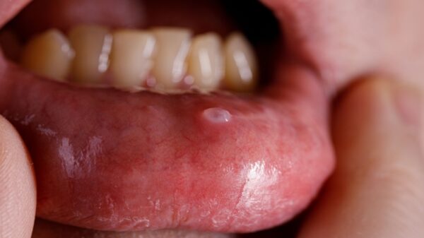 Lesões que não cicatrizam: conheça os sintomas do câncer de boca