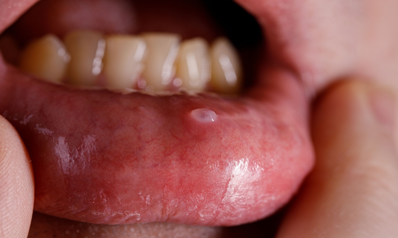 Lesões que não cicatrizam: conheça os sintomas do câncer de boca