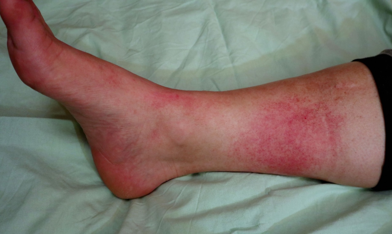 Primeiros sintomas da erisipela não surgem na pele; entenda
