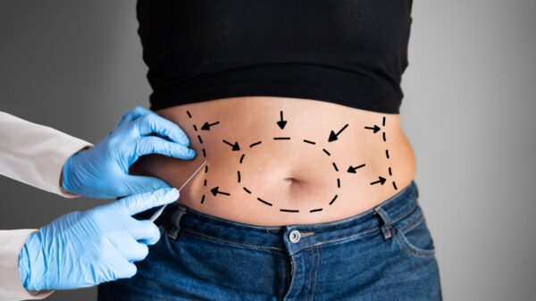 Cirurgião plástico responde 5 dúvidas sobre a abdominoplastia