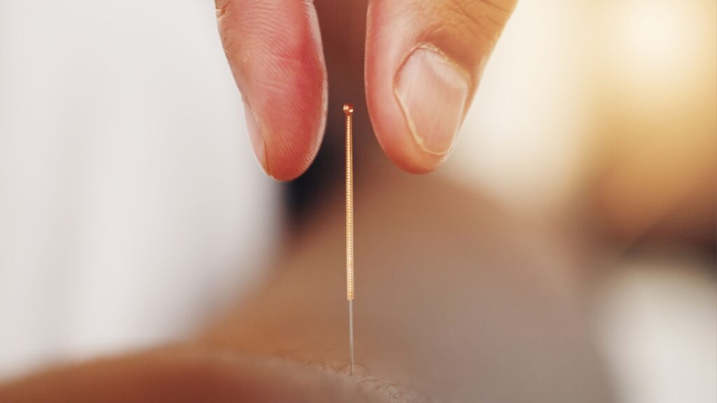 Saúde física e mental: veja o que a acupuntura pode tratar